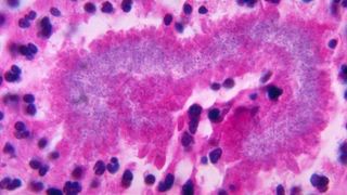 A multi-colored microscope image of tissue infected with nocardiosis. The image is mainly pink and purple in color. 