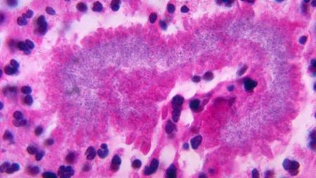 A multi-colored microscope image of tissue infected with nocardiosis. The image is mainly pink and purple in color. 